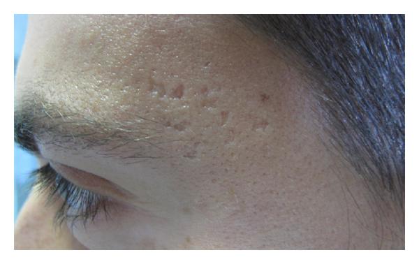 Offering Dermal Fillers to Treat Acne Scars